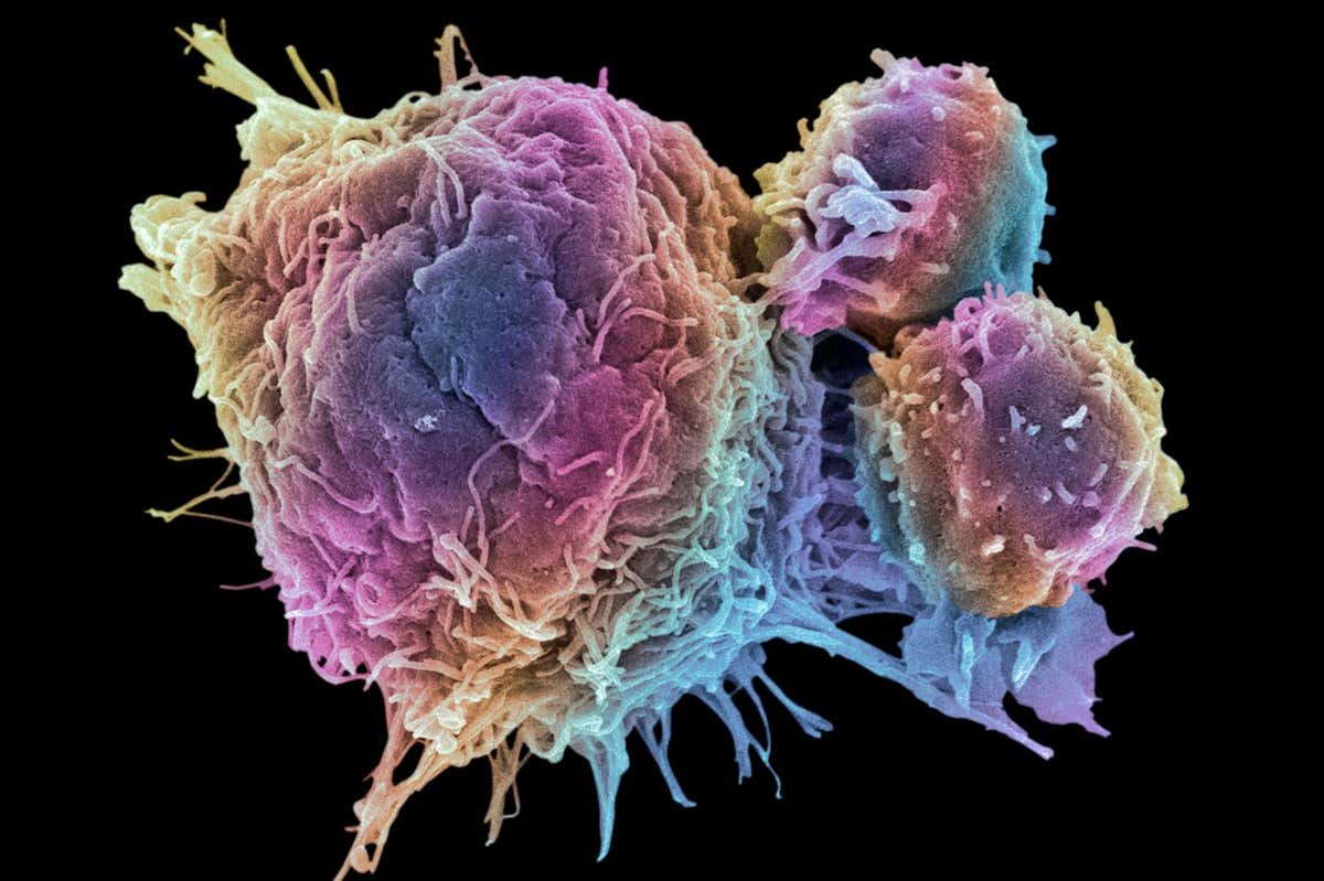 FGJJJ1 T lymphocytes and cancer cell. Coloured scanning electron micrograph (SEM) of T lymphocyte cells (smaller round cells) attached